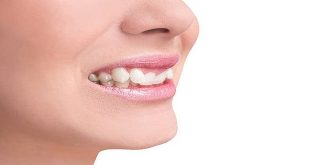 My Teeth Are Crooked - What's A Cost-Effective Way To Fix Them