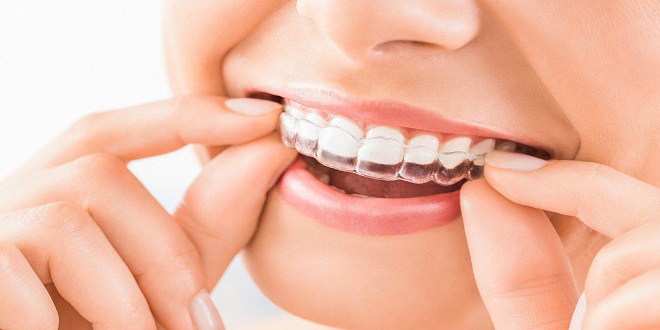 Is Underbite Teeth Making You Anxious Clear Aligners Are Here to Back You Up