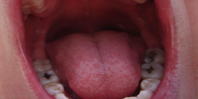 Is tooth filling process painful